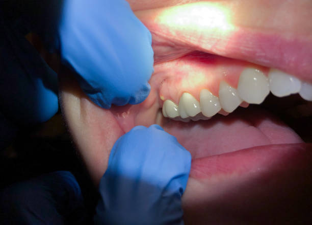 Best Emergency Wisdom Teeth Removal in Julian, CA